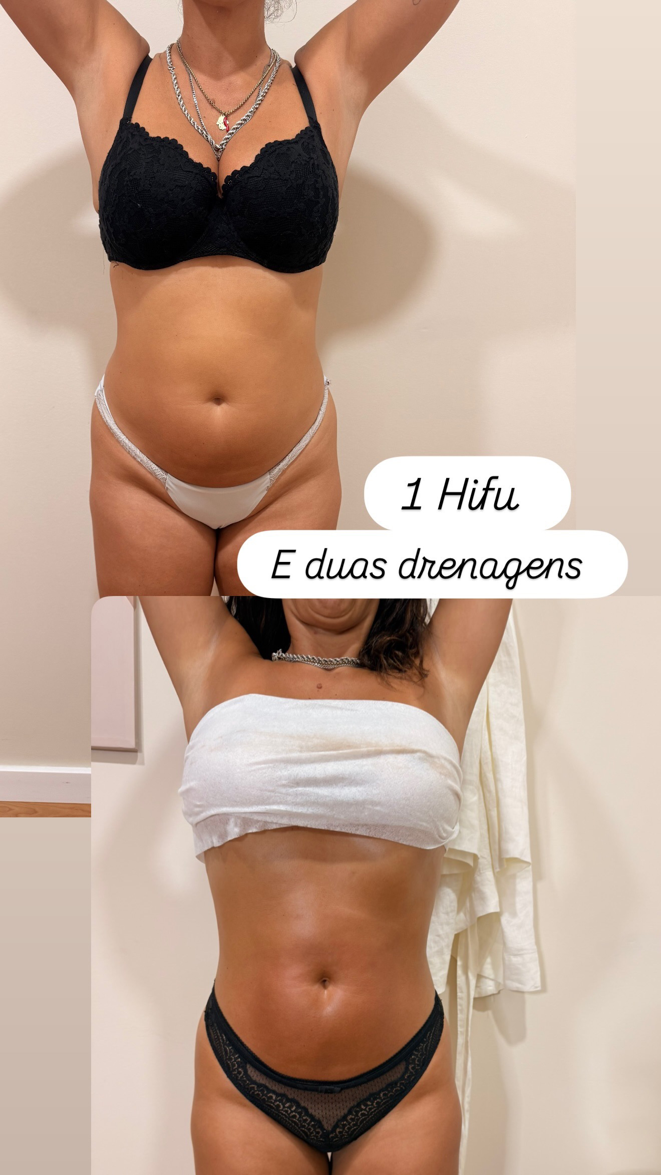 Depoimento Hifu abdomen pequeno