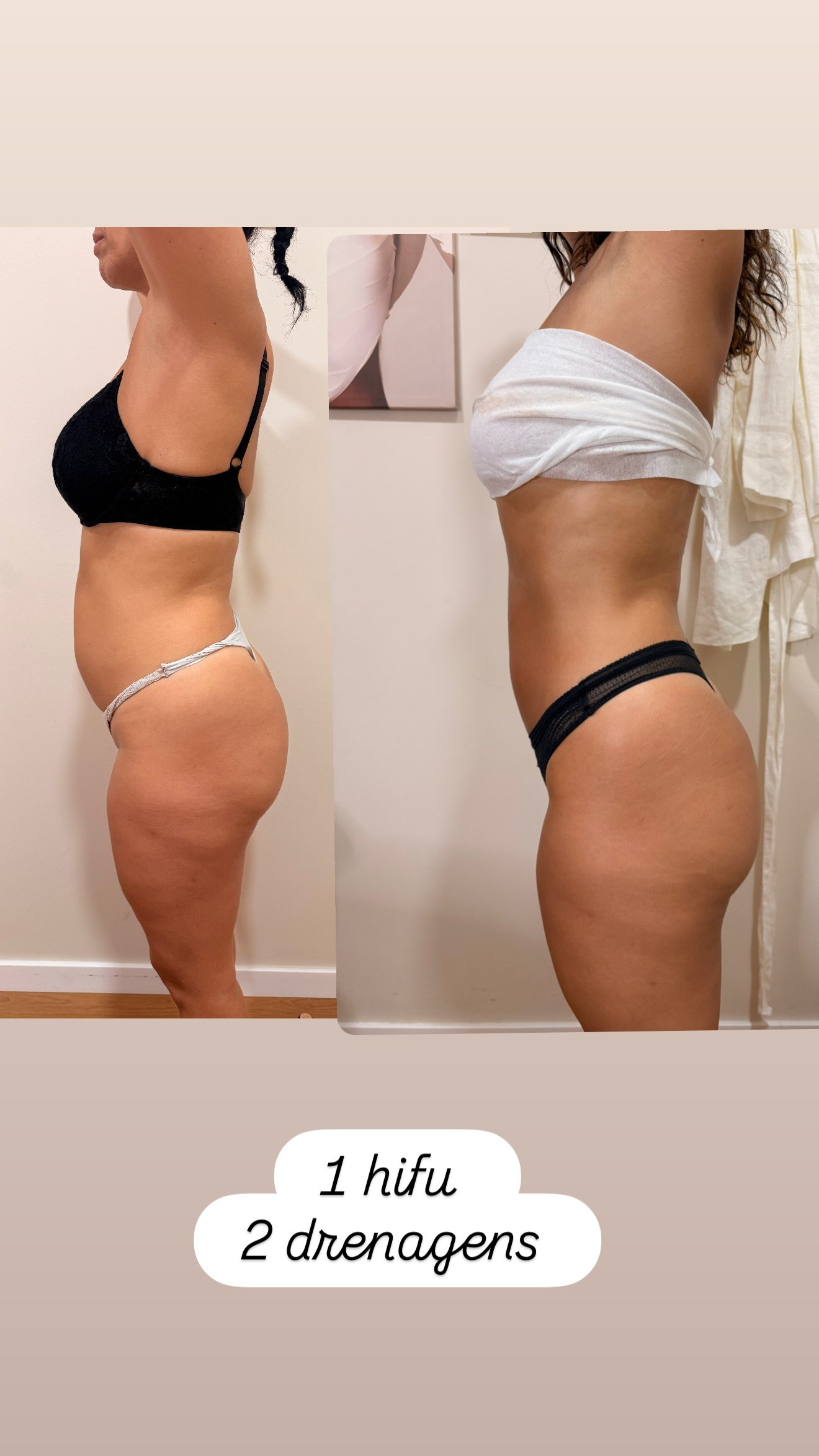 Depoimento Hifu abdomen pequeno